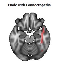 Inferior_Longitudinal_L126