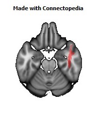 Inferior_Longitudinal_L130