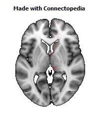 Medial_lemniscus_R104