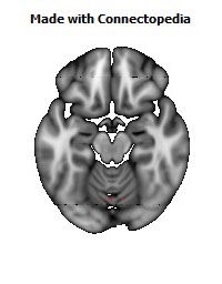 Middle_cerebellar_peduncle124