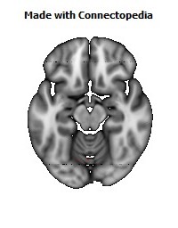 Middle_cerebellar_peduncle122