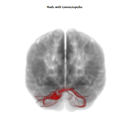 Middle Cerebellar Peduncle