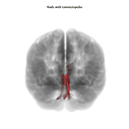 Posterior Commissure