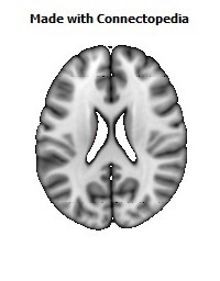 Posterior_Commissure086