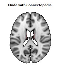 Posterior_Commissure088