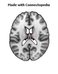 Posterior_Commissure090