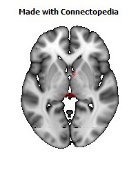 Posterior_Commissure108