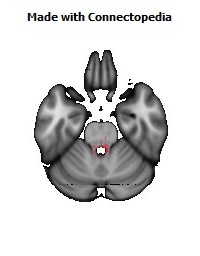 Posterior_Commissure134