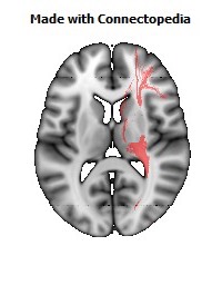 Posterior_corona_radiata_R096