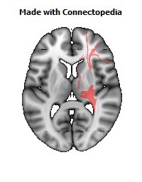 Posterior_corona_radiata_R098