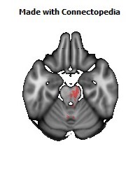 Posterior_corona_radiata_R130