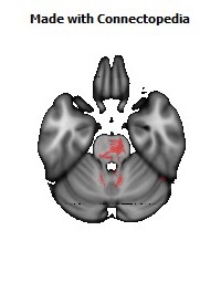 Posterior_corona_radiata_R134