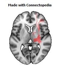 Posterior_corona_radiata_R102