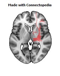 Posterior_corona_radiata_R104