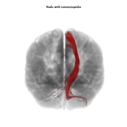 Posterior Limb of Internal Capsule