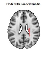 Posterior_limb_of_internal_capsule_R084