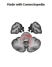 Posterior_limb_of_internal_capsule_R144