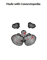 Posterior_limb_of_internal_capsule_R154