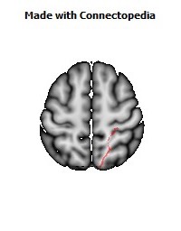 Posterior_thalamic_radiation_R052