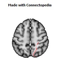 Posterior_thalamic_radiation_R056