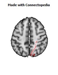 Posterior_thalamic_radiation_R060