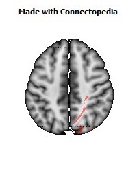 Posterior_thalamic_radiation_R062