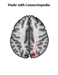 Posterior_thalamic_radiation_R066