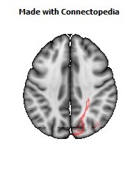 Posterior_thalamic_radiation_R070