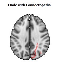 Posterior_thalamic_radiation_R072