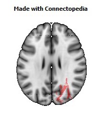 Posterior_thalamic_radiation_R080