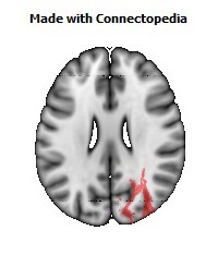 Posterior_thalamic_radiation_R082