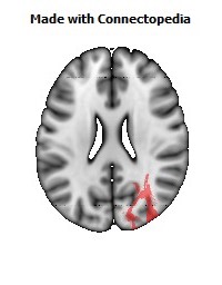 Posterior_thalamic_radiation_R084