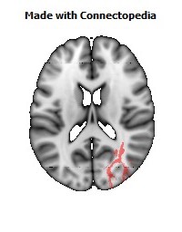 Posterior_thalamic_radiation_R090