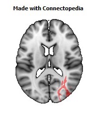 Posterior_thalamic_radiation_R092