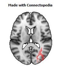 Posterior_thalamic_radiation_R094