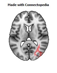 Posterior_thalamic_radiation_R096