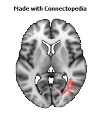 Posterior_thalamic_radiation_R102