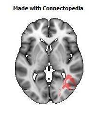 Posterior_thalamic_radiation_R106