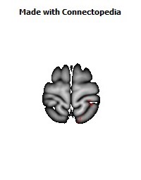 Posterior_thalamic_radiation_R038