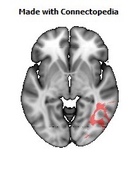 Posterior_thalamic_radiation_R112