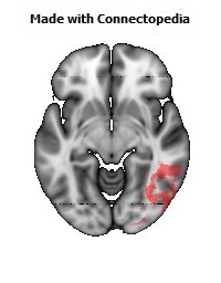 Posterior_thalamic_radiation_R116