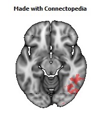 Posterior_thalamic_radiation_R120