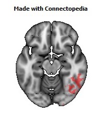 Posterior_thalamic_radiation_R122