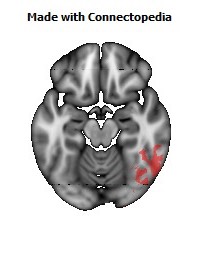 Posterior_thalamic_radiation_R124