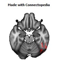 Posterior_thalamic_radiation_R128