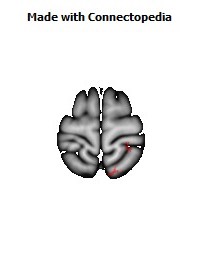 Posterior_thalamic_radiation_R040