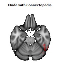 Posterior_thalamic_radiation_R132