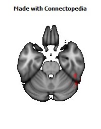 Posterior_thalamic_radiation_R134