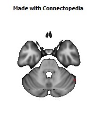 Posterior_thalamic_radiation_R138