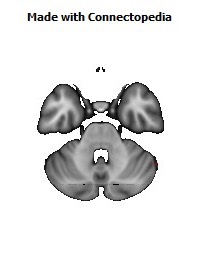 Posterior_thalamic_radiation_R140